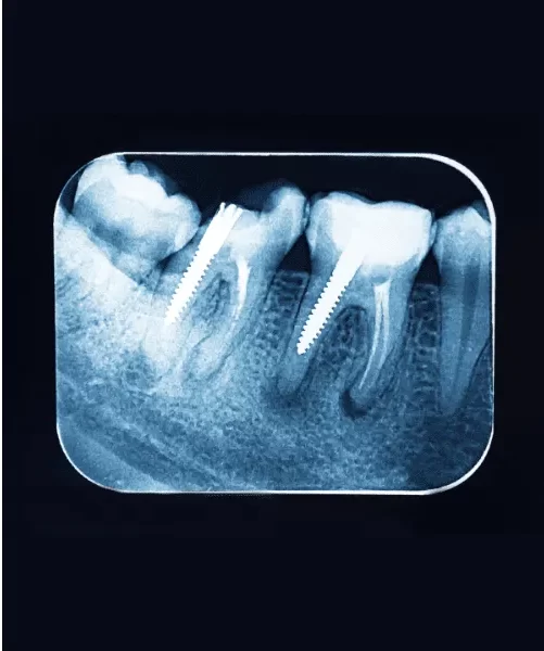 Root canal X-ray