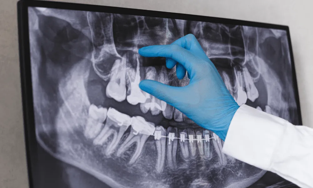 Root Canal X-ray Procedure